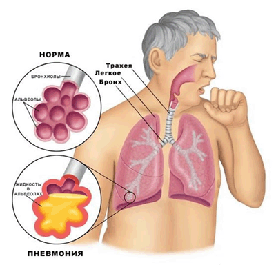 как вылечить сухой кашель